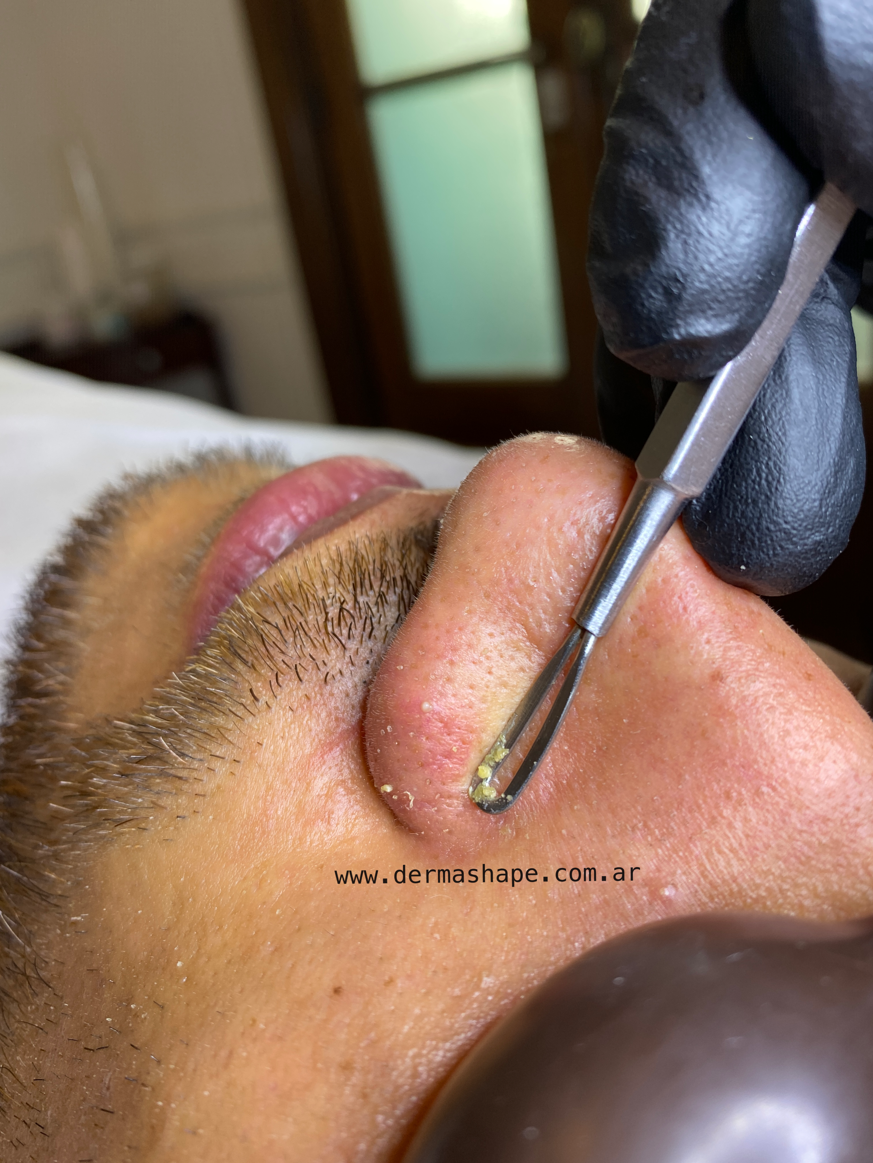 limpieza facial para hombres en palermo buenos aires the best blackheads removal facial service in buenos aires
